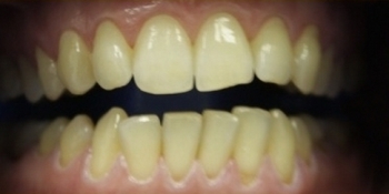 Отбеливание зубов последнего поколения ZOOM 3 - фото №1
