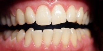 Отбеливание зубов последнего поколения ZOOM 3 - фото №2