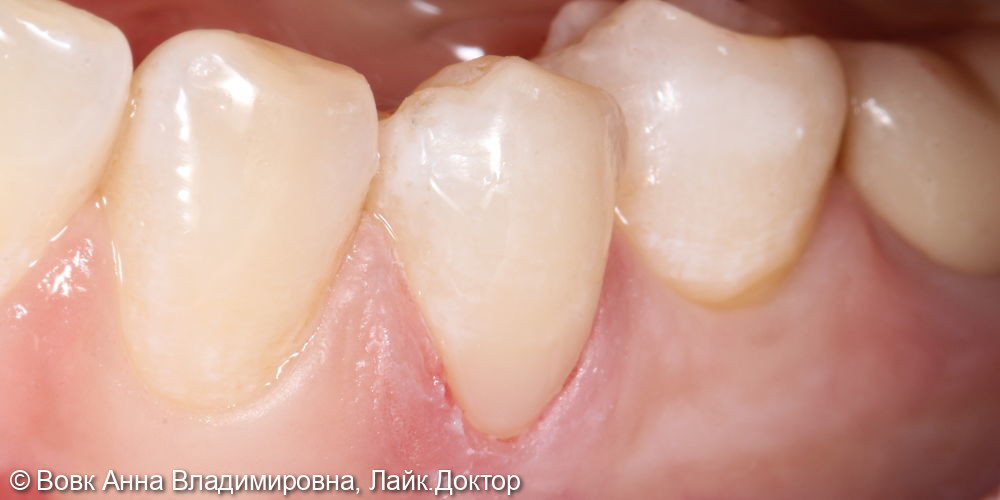 Лечение клиновидного дефекта 3.4 зуба - фото №2
