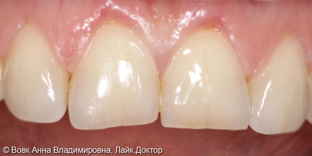 Реставрация 11 и 21 зубов - фото №1