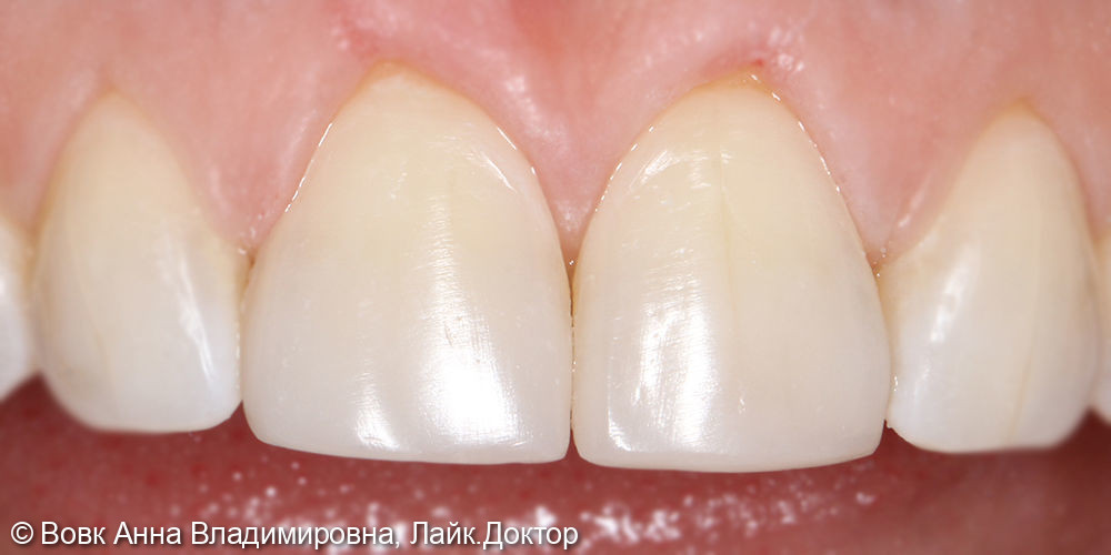 Реставрация 11 и 21 зубов - фото №2