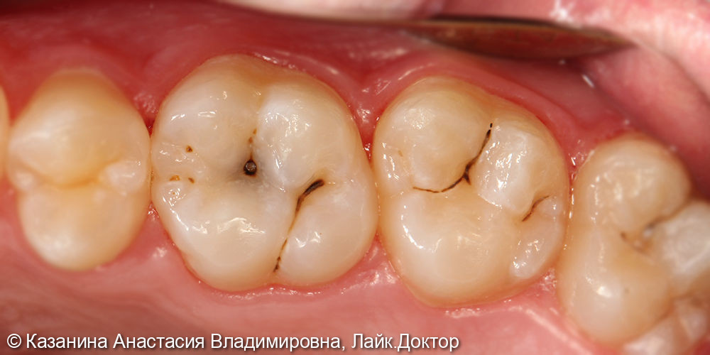 Лечение среднего кариеса 1.6, 1.7 зубов - фото №1