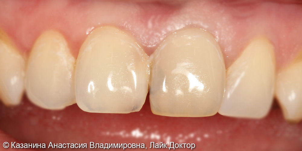Реставрация 11,21 зубов, внутриканальное отбеливание - фото №1