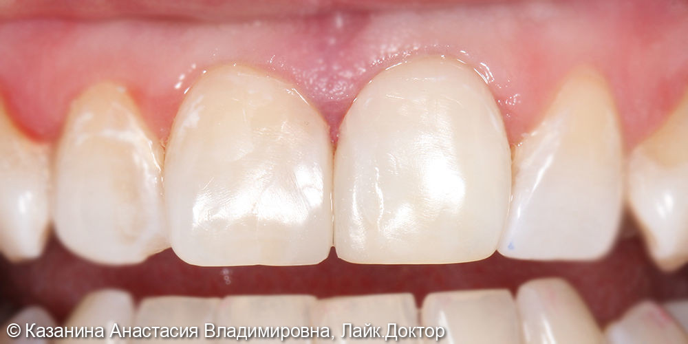 Реставрация 11,21 зубов, внутриканальное отбеливание - фото №2