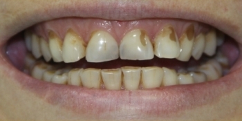 Эстетическая реставрация зубов - фото №1