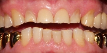 Полное восстановление зубов с помощью виниров и коронок - фото №1