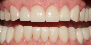 Полное восстановление зубов с помощью виниров и коронок - фото №2