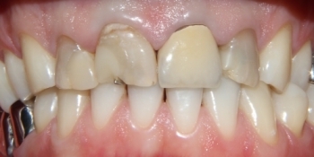 Восстановление зубов с помощью виниров и коронок - фото №1