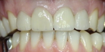 Восстановление зубов с помощью виниров и коронок - фото №2
