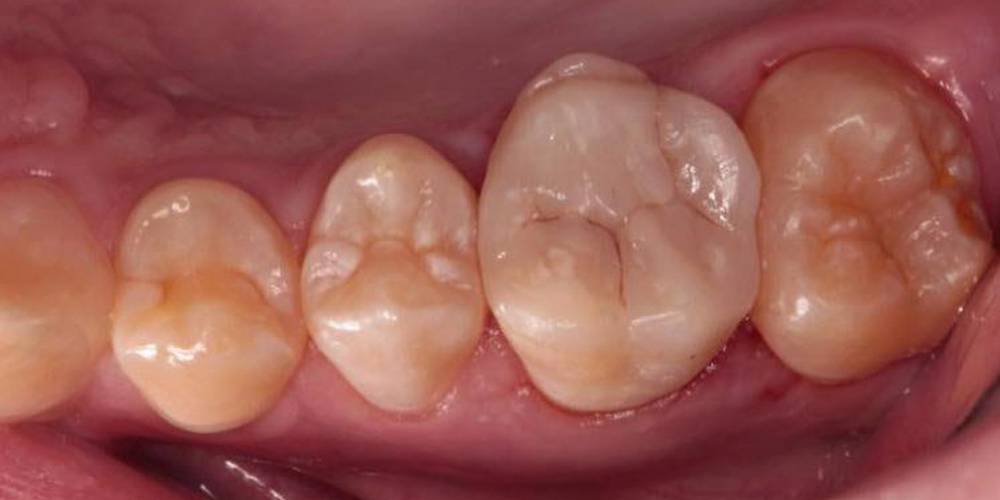 Результат восстановления зуба композитной накладкой - фото №8