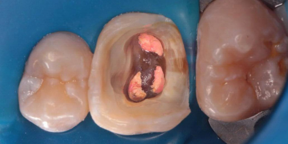 Результат восстановления зуба композитной накладкой - фото №3
