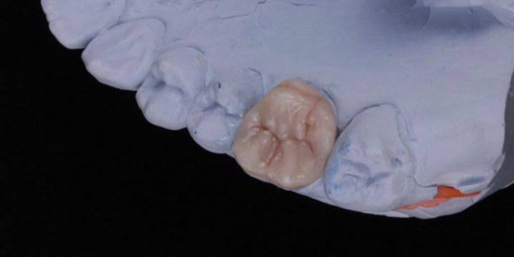 Результат восстановления зуба композитной накладкой - фото №5