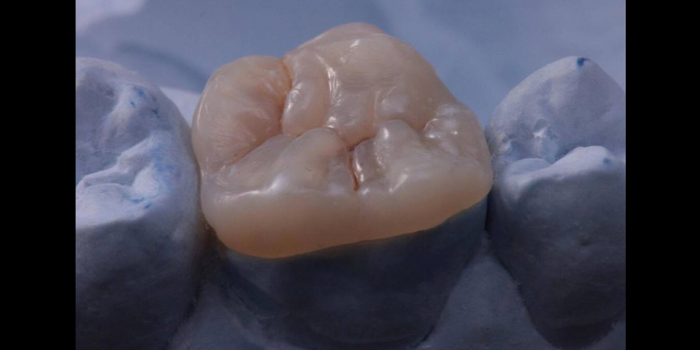 Результат восстановления зуба композитной накладкой - фото №7
