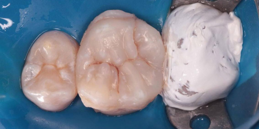Результат восстановления зуба композитной накладкой - фото №2