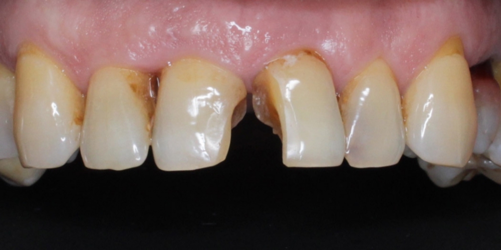 Восстановление передних зубов композитным материалом и коронками - фото №1