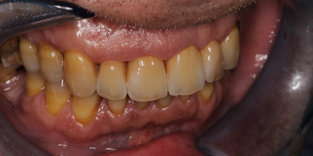 Восстановление передних зубов композитным материалом и коронками - фото №2