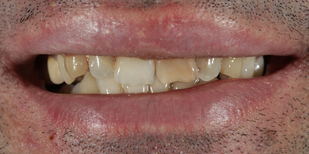 Исправление неровности зубного ряда и дисколорита при помощи 4-х керамических виниров - фото №1