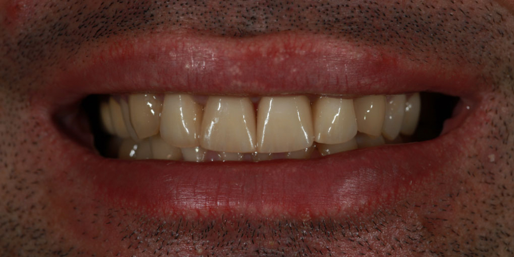 Исправление неровности зубного ряда и дисколорита при помощи 4-х керамических виниров - фото №2