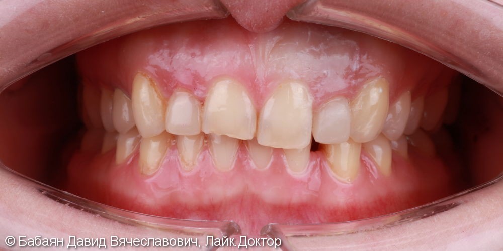 Установка 4-х виниров e.Max на передние зубы верхней челюсти - фото №1