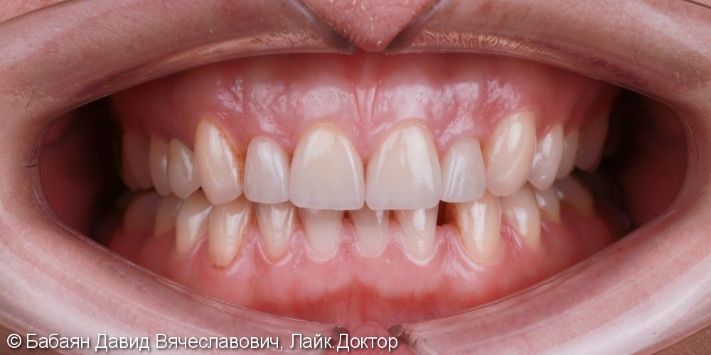 Установка 4-х виниров e.Max на передние зубы верхней челюсти - фото №2