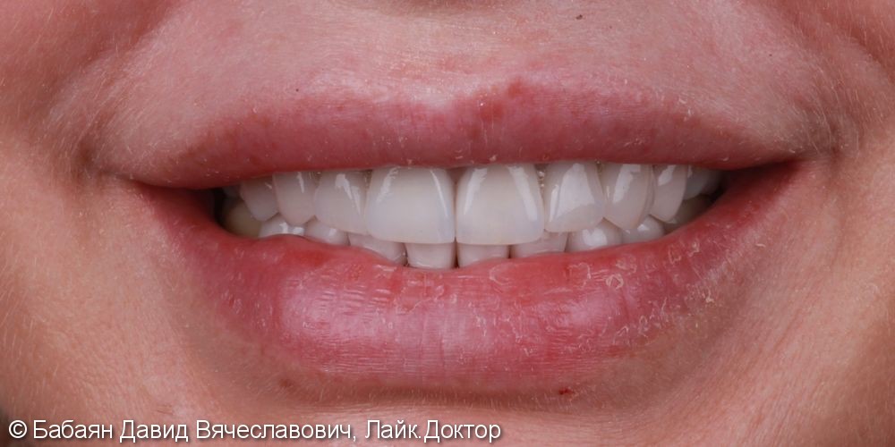 Керамические винницы e.Max, а на задние зубы были установлены керамические накладки - фото №2