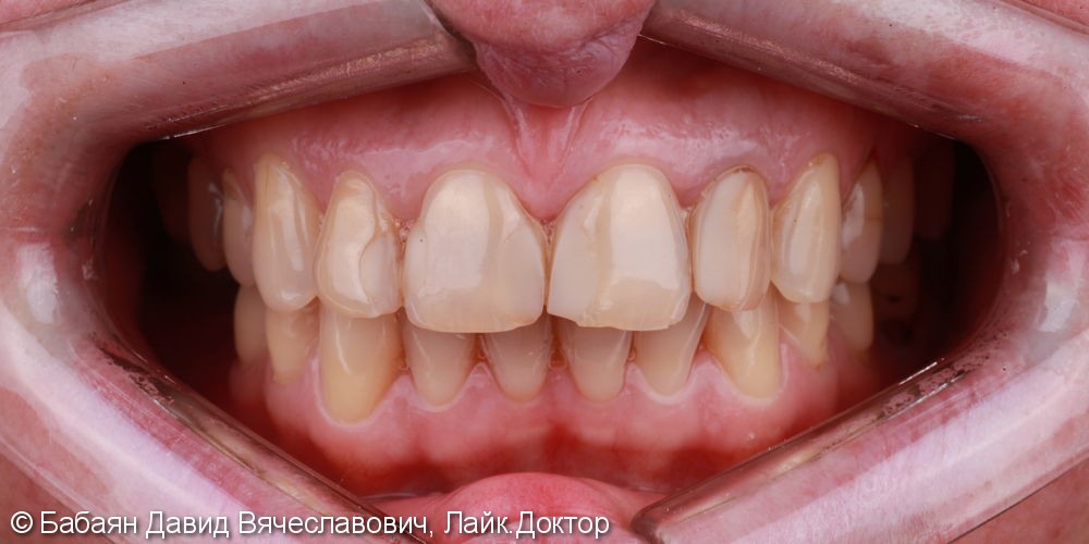 Новые зубы в оттенке Bleach 3, керамические виниры - фото №1