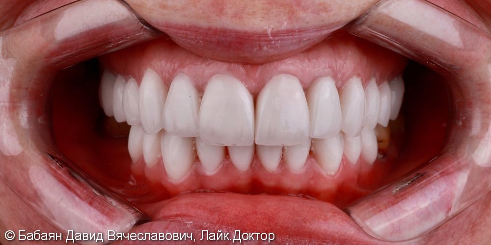 Новые зубы в оттенке Bleach 3, керамические виниры - фото №2