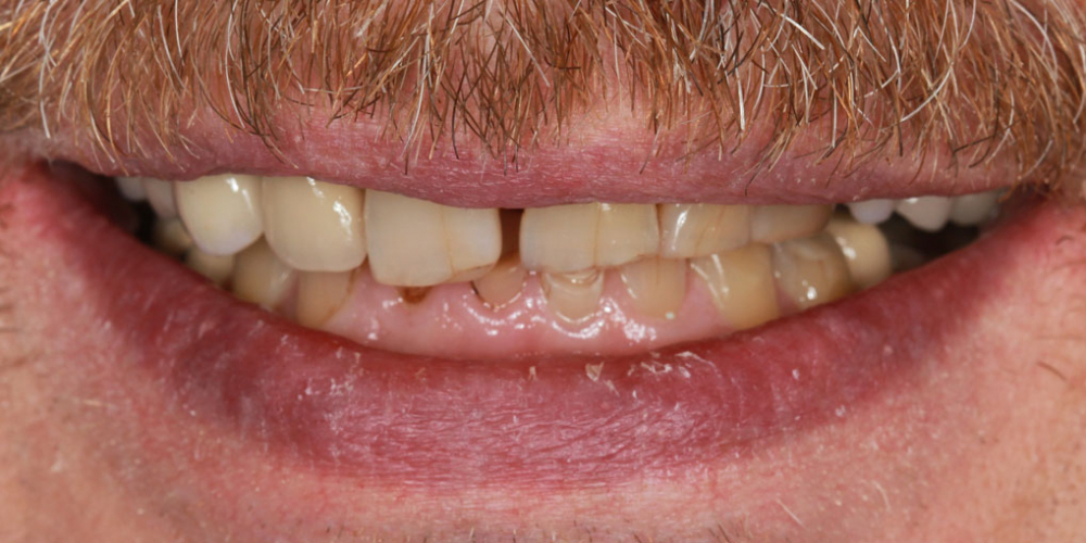 Тотальная стоматологическая реабилитация пациента: 12 имплантов + 28 виниров - фото №1