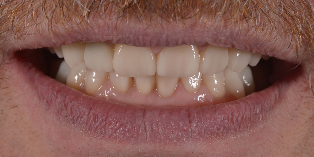 Тотальная стоматологическая реабилитация пациента: 12 имплантов + 28 виниров - фото №8