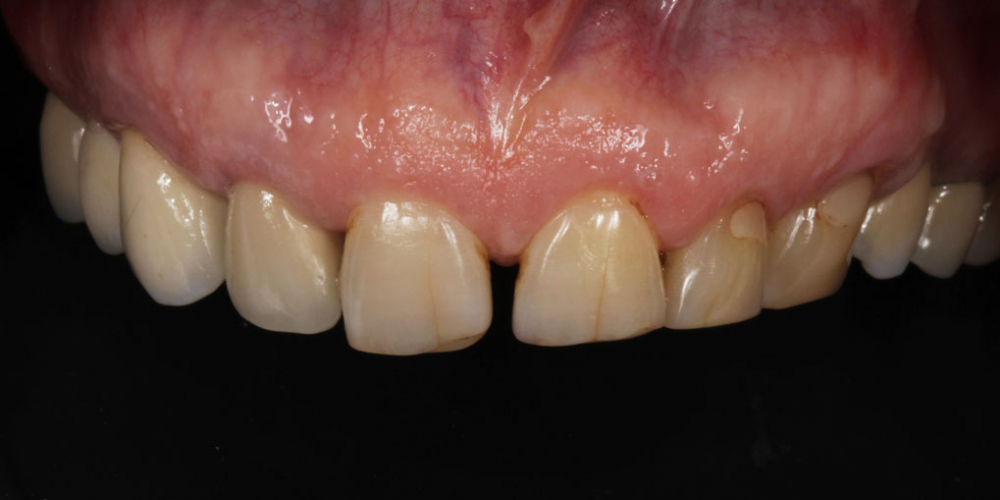 Тотальная стоматологическая реабилитация пациента: 12 имплантов + 28 виниров - фото №3