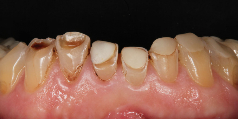 Тотальная стоматологическая реабилитация пациента: 12 имплантов + 28 виниров - фото №4