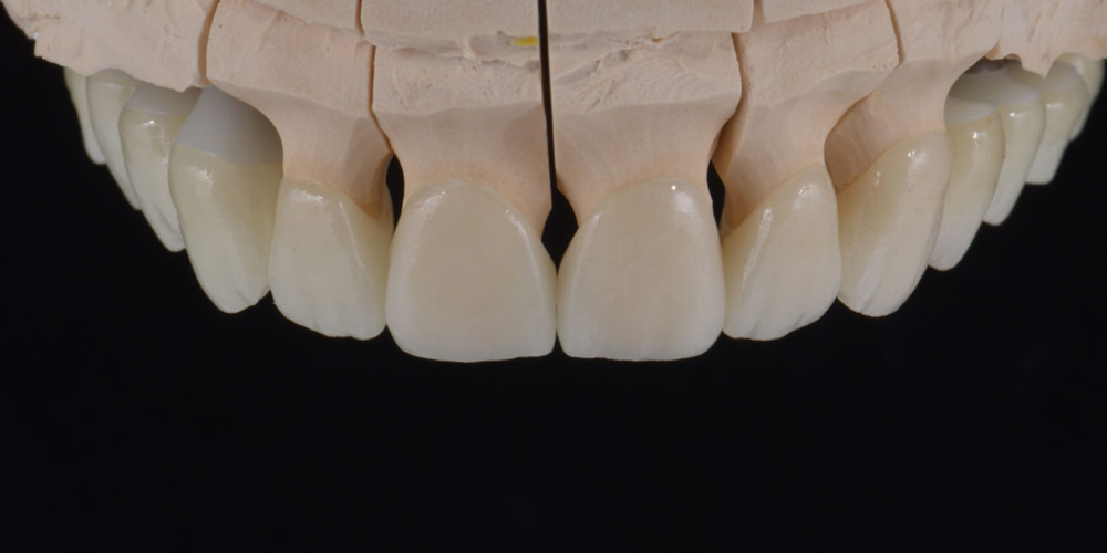 Тотальная стоматологическая реабилитация пациента: 12 имплантов + 28 виниров - фото №5