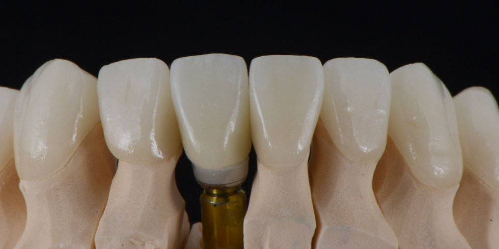 Тотальная стоматологическая реабилитация пациента: 12 имплантов + 28 виниров - фото №6
