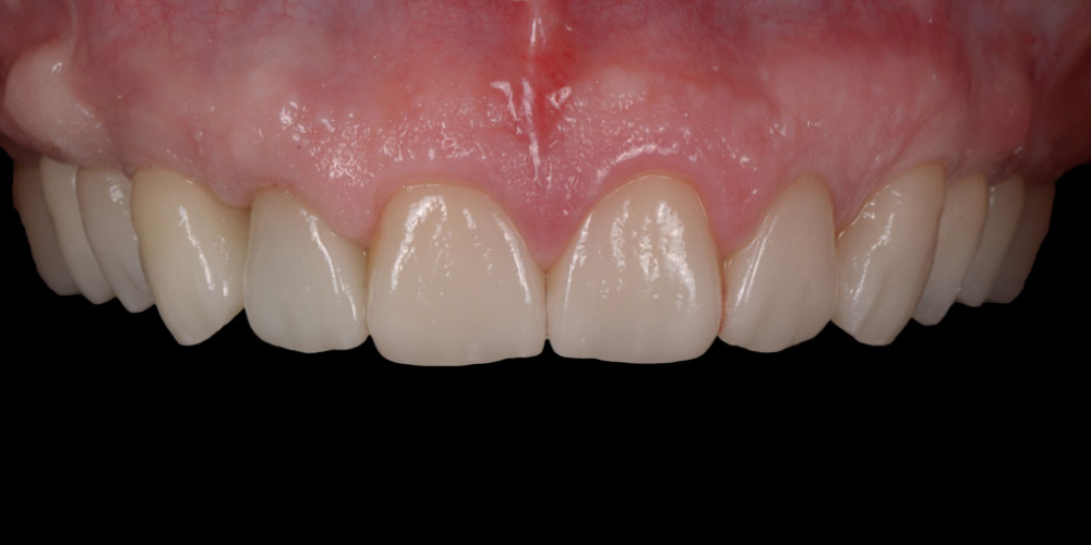 Тотальная стоматологическая реабилитация пациента: 12 имплантов + 28 виниров - фото №7