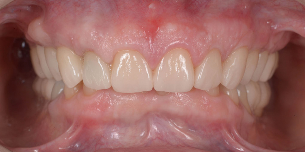 Тотальная стоматологическая реабилитация пациента: 12 имплантов + 28 виниров - фото №2