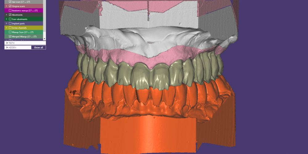 Полное восстановление двух челюстей на 16 имплантатах - фото №5