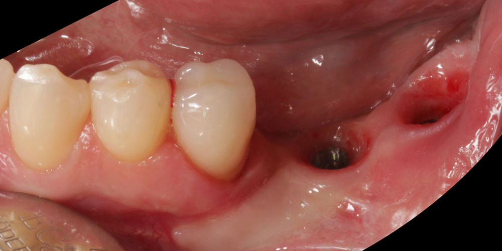 Цельнокерамические реставрации на зубах и имплантатах с опорой на индивидуальные абатменты - фото №3