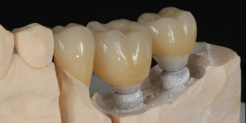 Цельнокерамические реставрации на зубах и имплантатах с опорой на индивидуальные абатменты - фото №4