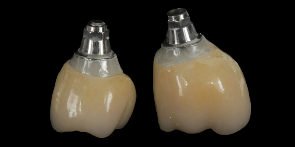 Цельнокерамические реставрации на зубах и имплантатах с опорой на индивидуальные абатменты - фото №2