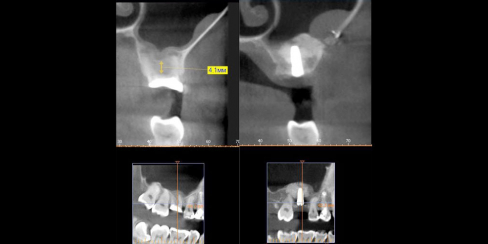 Восстановление зуба имплантацией + синус-лифтинг - все в один этап - фото №2