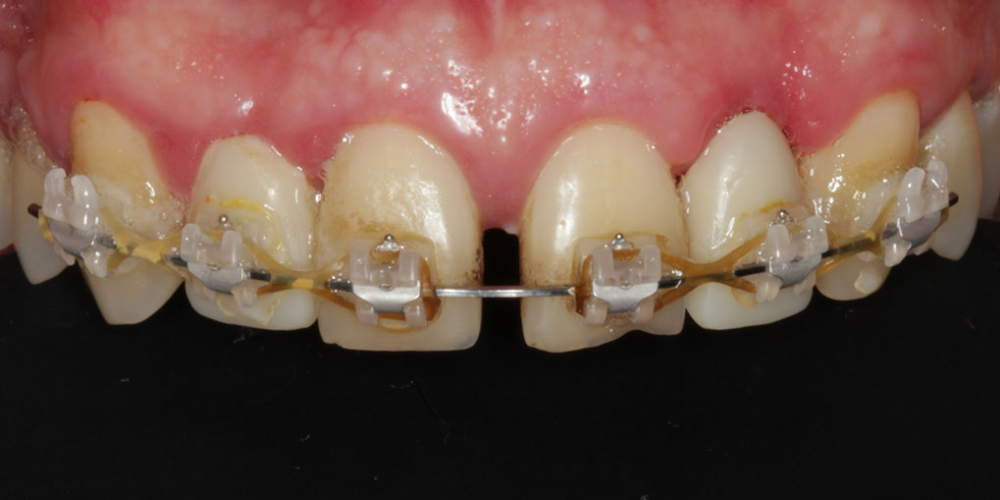 Эстетическое протезирование передних верхних зубов с предварительным исправлением прикуса и импланта - фото №3