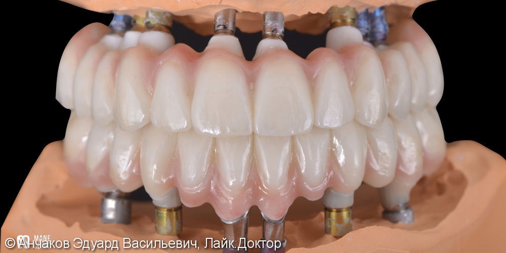 Тотально протезирование двух челюстей с импользованием дентальных имплантатов - фото №3