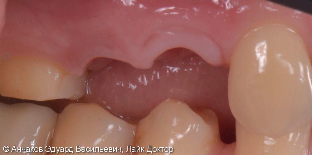 Одномоментная имплантация с пластикой десны и немедленной нагрузкой в боковом отделе верхней челюсти - фото №2