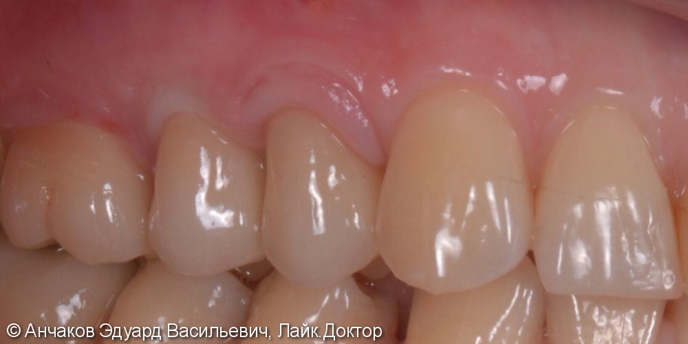 Одномоментная имплантация с пластикой десны и немедленной нагрузкой в боковом отделе верхней челюсти - фото №4