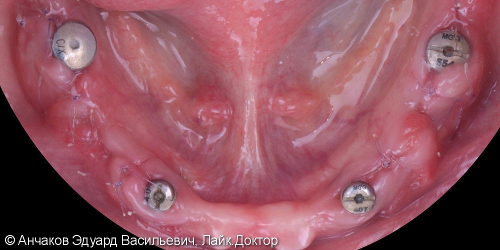 Имплантация зубов all - on - four (все на 4-х) на нижней чеслюсти и протезирование - фото №1