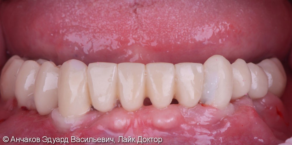 Имплантация зубов all - on - four (все на 4-х) на нижней чеслюсти и протезирование - фото №2