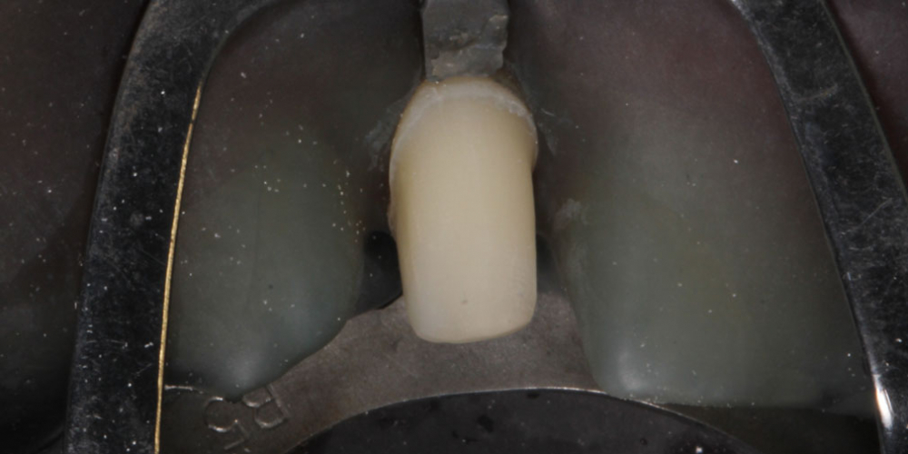 Исправление боковых резцов верхней челюсти керамическими винирами - фото №7
