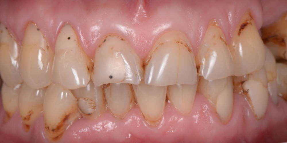Тотальная стоматологическая реабилитация пациента: 6 дентальных имплантов, 28 керамических виниров - фото №1