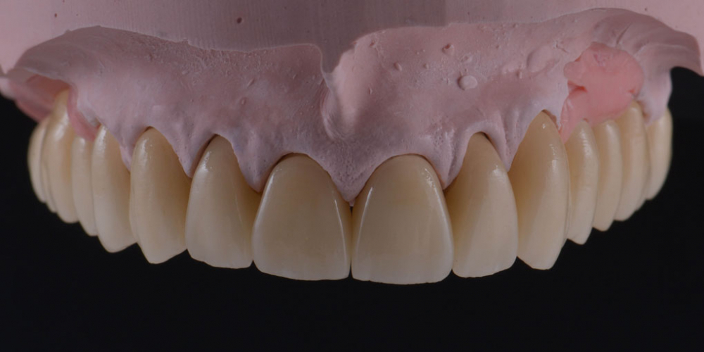 Тотальная стоматологическая реабилитация пациента: 6 дентальных имплантов, 28 керамических виниров - фото №3