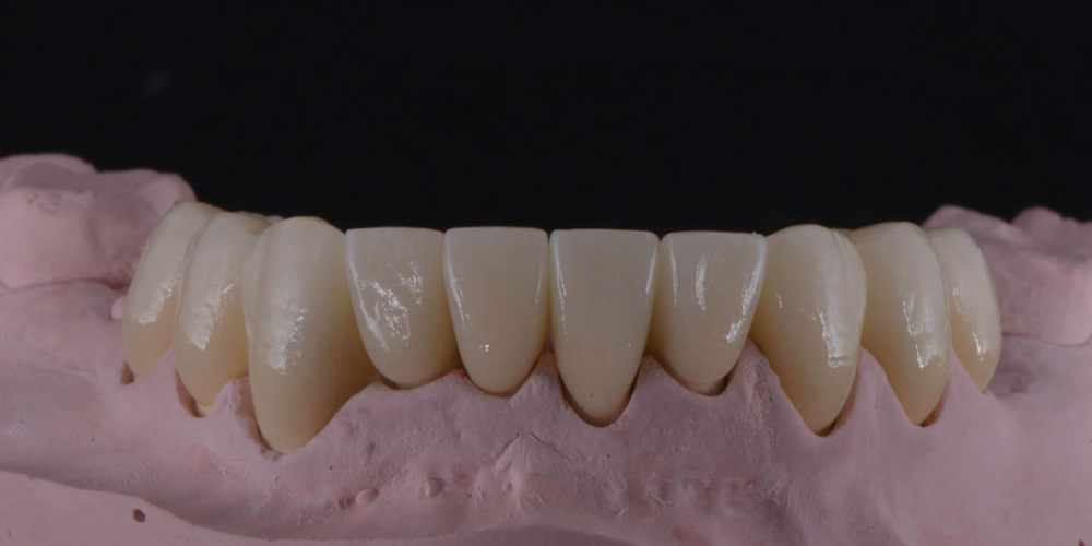 Тотальная стоматологическая реабилитация пациента: 6 дентальных имплантов, 28 керамических виниров - фото №4